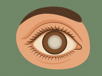 Chirurgia della Cataratta